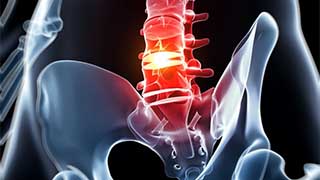 sciatica causing lower back pain